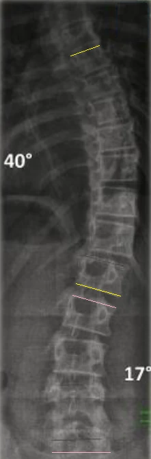 Radiografia vera di una scoliosi con gli angoli di Cobb tracciati sui piatti vertebrali: 40 gradi la curva superiore e 17 gradi quella inferiore