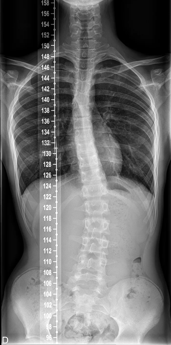 Radiografia vera della colonna intera in piedi con una scoliosi sinistro convessa nel passaggio fra tratto dorsale e lombare; la lettera D in basso a sinistra indica il lato destro del paziente